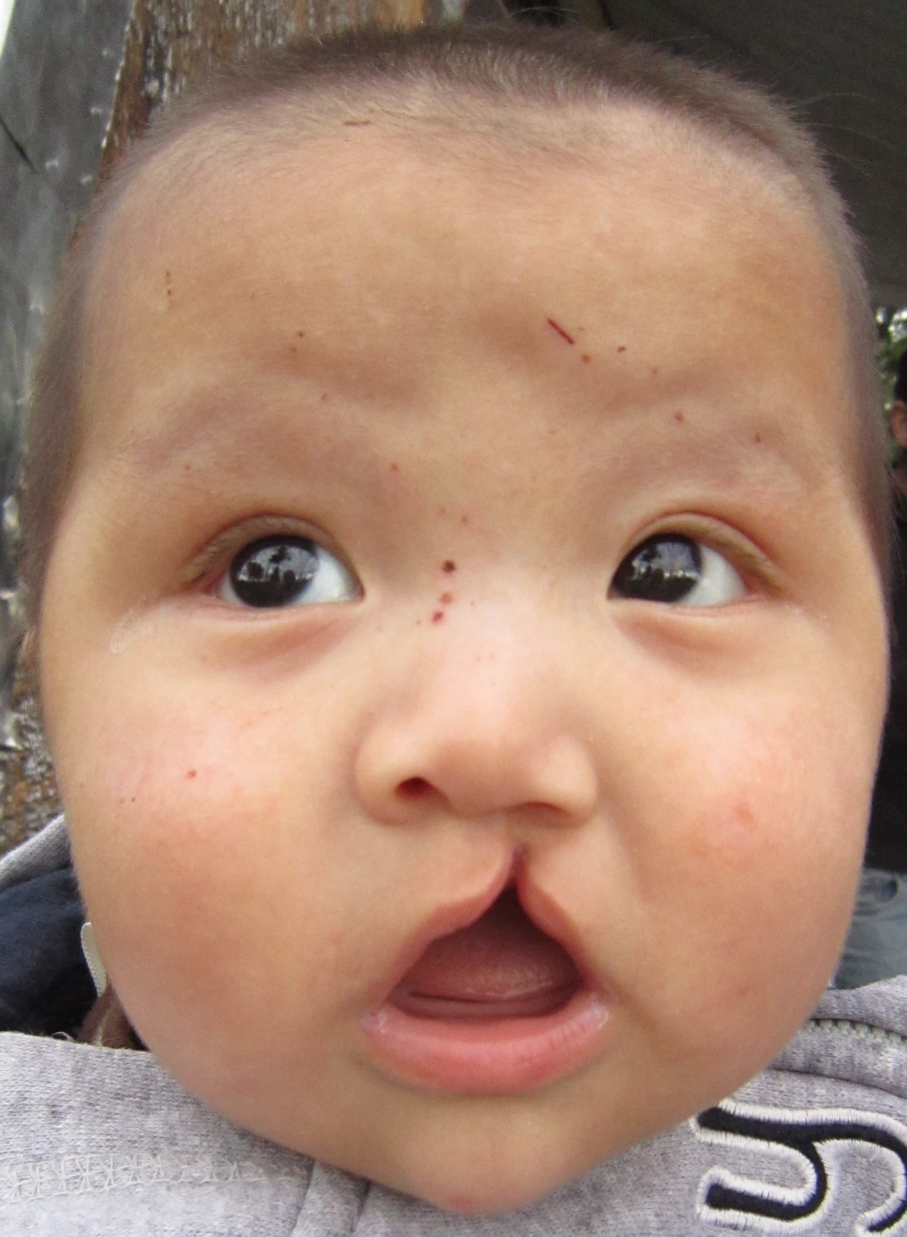 Cleft Lip Repair